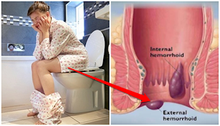 Obat Herbal Ambeien Kronis